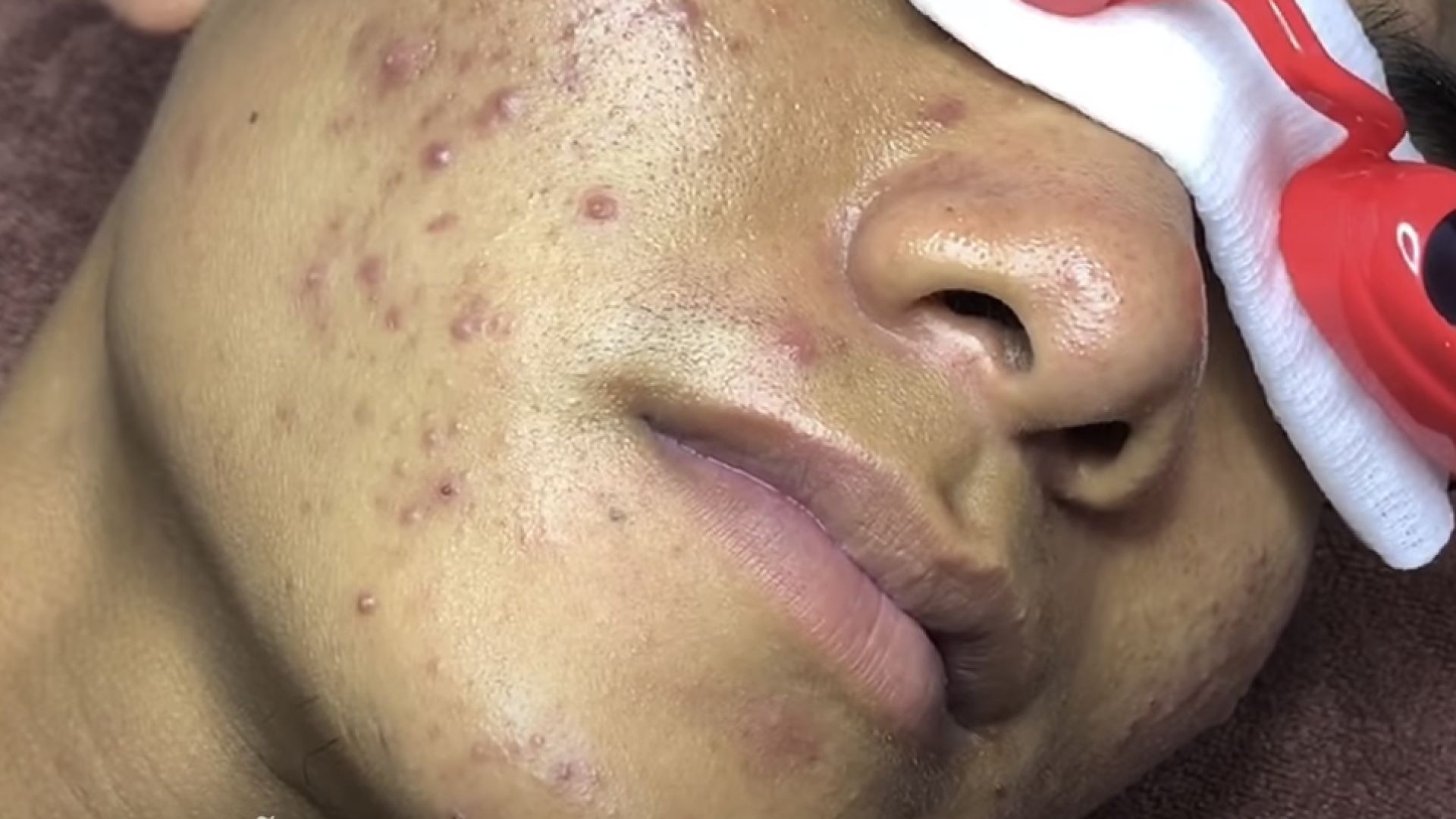 Dermatologist treating squeeze pimples, whitehead blackhead, pustule, anti acnes full face|Mụn mặt