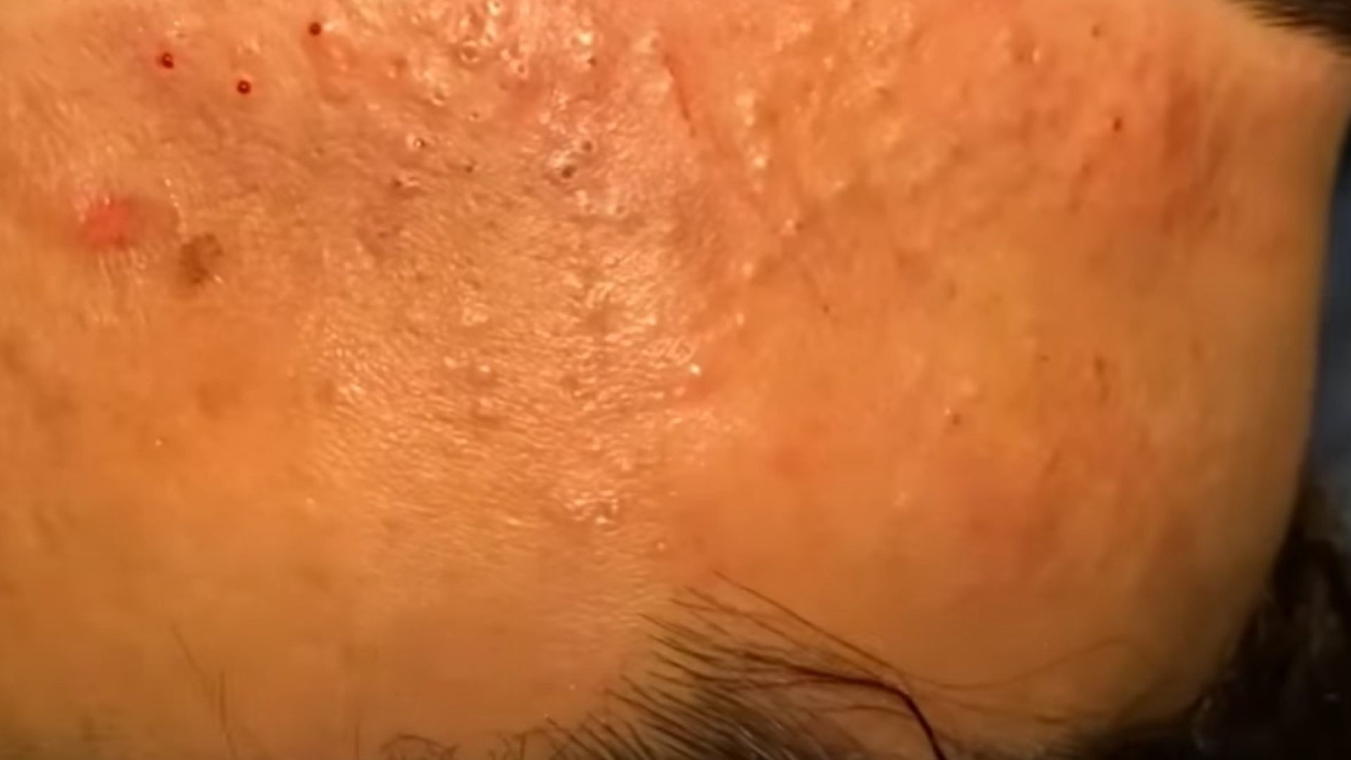Whiteheads and Blackheads with Dr. Lalit