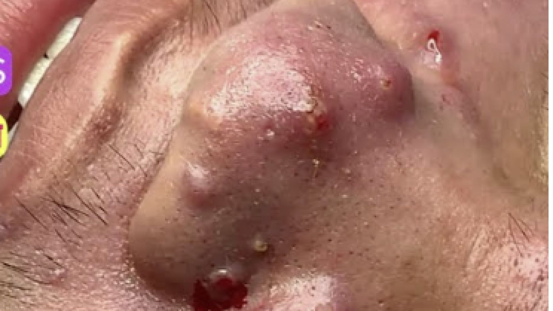 Mụn mủ siêu nhiều mụn viêm|Big acnes pimples,pusstule,blackheads extraction Dr Hoan 0985773391