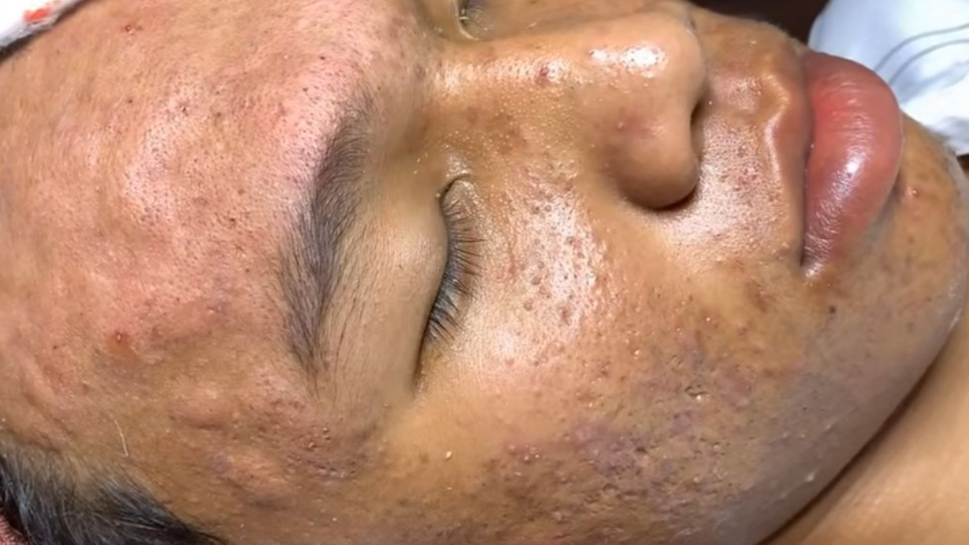 MEMORIES_remove BLACKHEADS 21 | Loan Nguyen