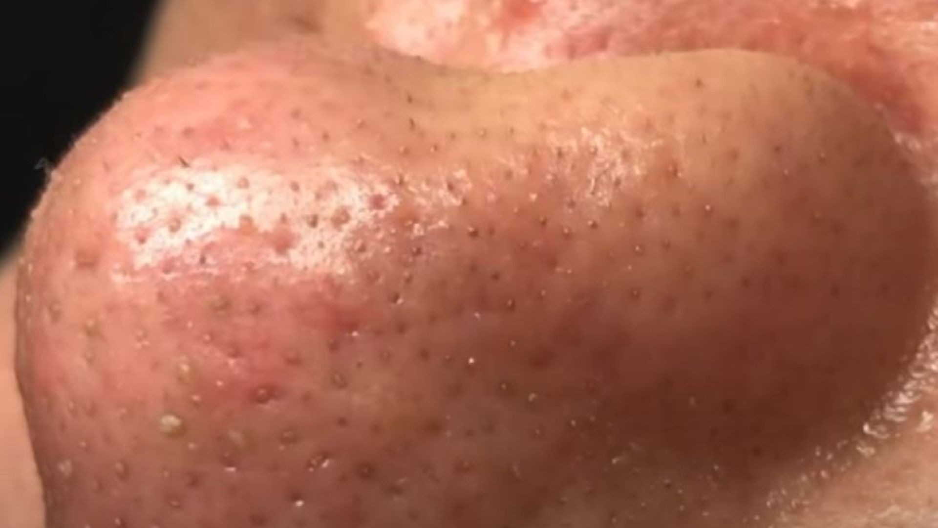 Volume from a small nose pimple