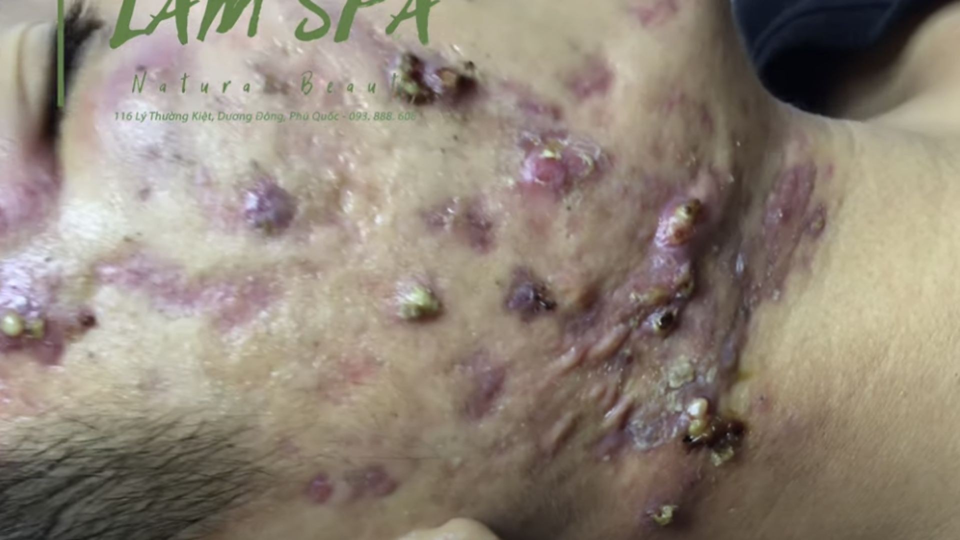 Treatment of acne pustules, severe inflammation | Điều trị mụn mủ viêm nặng | LAMSPA PHU QUOC | L P1